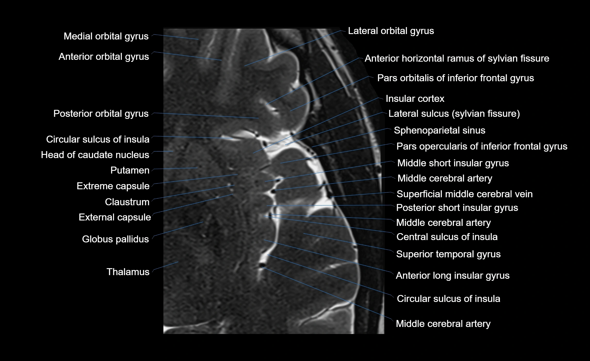 Brain insula axial  anatomy 3T MRI image-img-00001-00009.webp